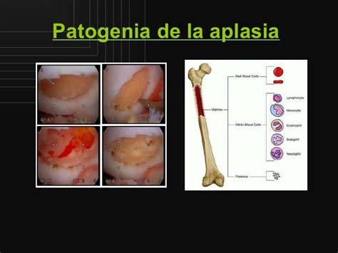 aplazie medulara